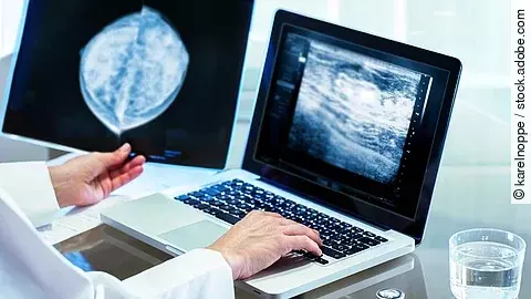 Nahaufnahme eines medizinischen Arbeitsplatzes: Auf einem Laptop und einem Monitor sind Mammographie-Aufnahmen zu sehen, daneben eine Hand mit Stift, die die Befunde prüft.