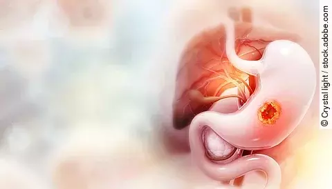 Magenkarzinom - 3D-Illustration