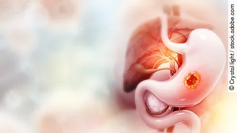 Magenkarzinom - 3D-Illustration Magenkarzinom - 3D-Illustration