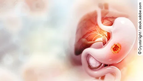 Stomach cancer, gastric cancer, symptoms, stages, treatment, 3d illustration