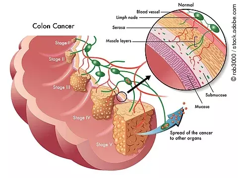 Illustration eines menschlichen Darms mit unterschiedlich weit forteschrittenen Tumorstandien