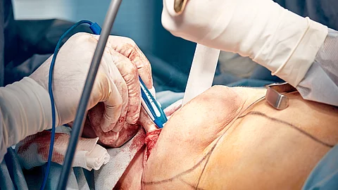 Mamoplasty, breast reconstruction, the surgeon's hands place an 