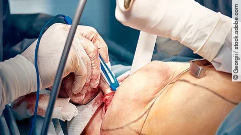 Mamoplasty, breast reconstruction, the surgeon's hands place an 