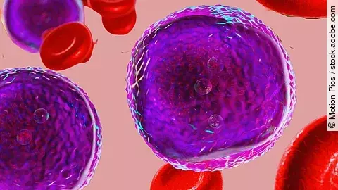 Akute lymphoblastische Leukämie - Krebszellen und Erythrozyten