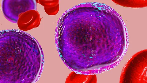 Akute lymphoblastische Leukämie - Krebszellen und Erythrozyten
