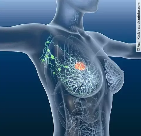 Breast cancer, lymphatics, mastocarcinoma