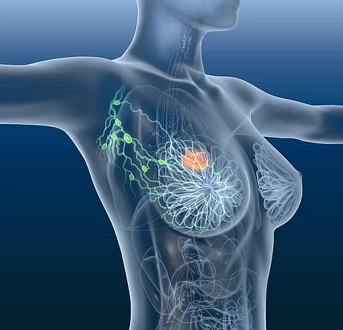 Breast cancer, lymphatics, mastocarcinoma
