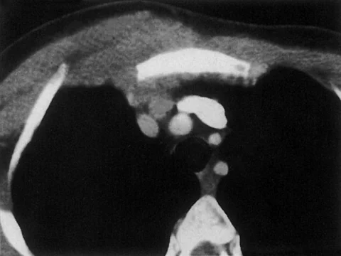 CT des Hals und Thorax