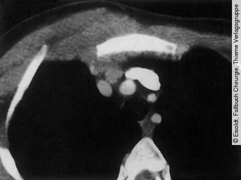 CT des Hals und Thorax