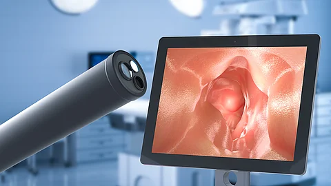Endoskop während einer Darmspiegelung mit Monitoransicht des Darminneren zur Abklärung eines positiven Stuhltests im Rahmen der Darmkrebsvorsorge.