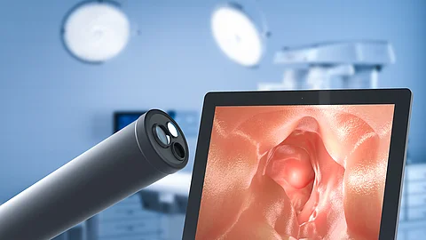 Endoskop während einer Darmspiegelung mit Monitoransicht des Darminneren zur Abklärung eines positiven Stuhltests im Rahmen der Darmkrebsvorsorge. Medical technology concept