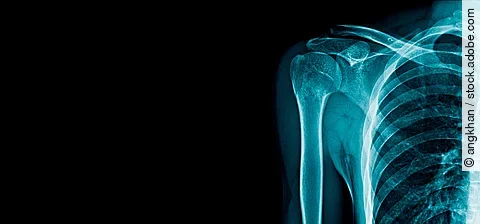 Röntgenaufnahme von Knochen im Schulter- und Brustbereich