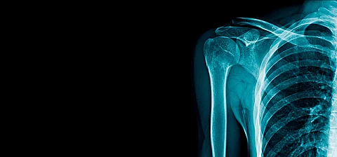 Röntgenaufnahme von Knochen im Schulter- und Brustbereich