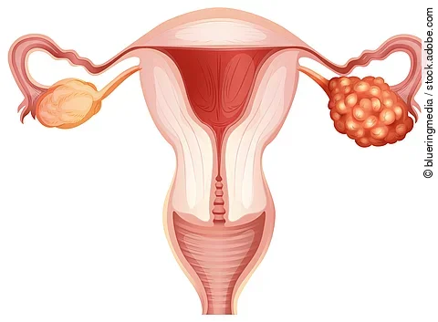 Ovarian cancer in woman