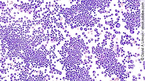 Mikroskopische Aufnahme von Knochenmarkzellen – typische Zellstrukturen, wie sie bei der Diagnose des multiplen Myeloms untersucht werden.