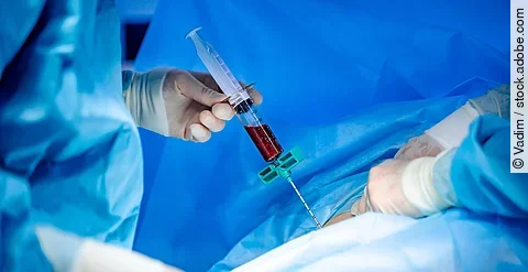 Platelet-Rich plasma preparation. Plasma in syringe. Modern equipment in operating room.