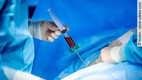 medizinische Szene während einer Knochenmarkentnahme