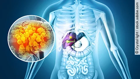 Geschädigte Leber - z.B. Fettleber, Zirrhose, Fibrose oder Leberkrebs