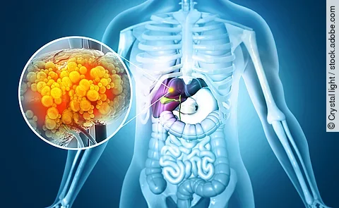 Liver damage such as Fatty liver, Fibrosis, Cirrhosis, and Liver cancer. 3d illustration