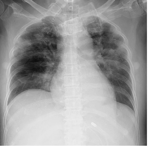Röntgen-Thorax der Patientin mit Leukämie