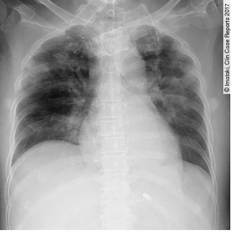 Röntgen-Thorax der Patientin mit Leukämie