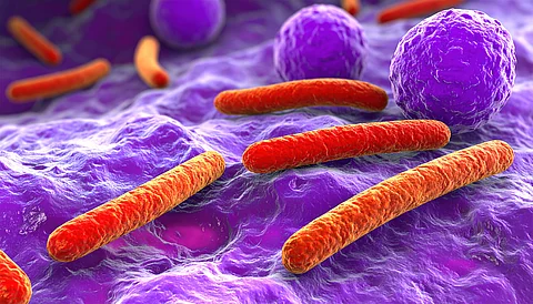 Mikroskopische Aufnahme von Fusobakterien assoziiert mit Krebszellen im Darm Mikroskopische Aufnahme von Fusobakterien assoziiert mit Krebszellen im Darm