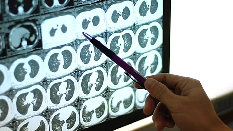 Hand mit Stift zeigt auf mehrere CT-Querschnittsbilder des Brustkorbs auf einem Leuchtbildschirm