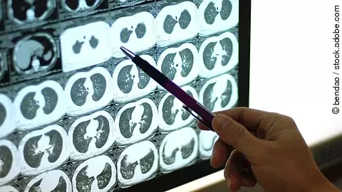 Hand mit Stift zeigt auf mehrere CT-Querschnittsbilder des Brustkorbs auf einem Leuchtbildschirm Hand mit Stift zeigt auf mehrere CT-Querschnittsbilder des Brustkorbs auf einem Leuchtbildschirm