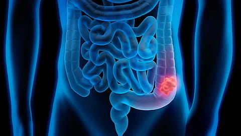 Illustration des menschlichen Darms mit hervorgehobenem Tumorbereich im Dickdarm, dargestellt in blauen Farbtönen mit kontrastiertem rötlichen Tumor.