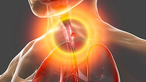 Esophageal cancer, illustration