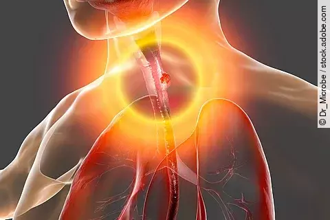Esophageal cancer, illustration