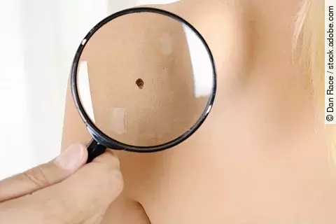 Patient mit Hautkrebs oder Muttermal