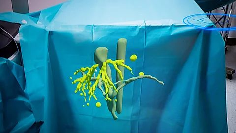 Eine OP-Liege mit blauer Abdeckung, darüber schwebend eine gelbe holografische Darstellung von Gefäßstrukturen, sichtbar durch Augmented-Reality-Technologie. Eine OP-Liege mit blauer Abdeckung, darüber schwebend eine gelbe holografische Darstellung von Gefäßstrukturen, sichtbar durch Augmented-Reality-Technologie.