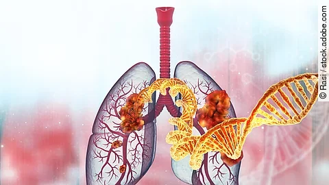 Lungenkrebsrisiko bei ILD-Patienten verdoppelt Lungenkrebsrisiko bei ILD-Patienten verdoppelt