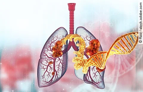 Human lung cancer with dna strand. 3d illustration.