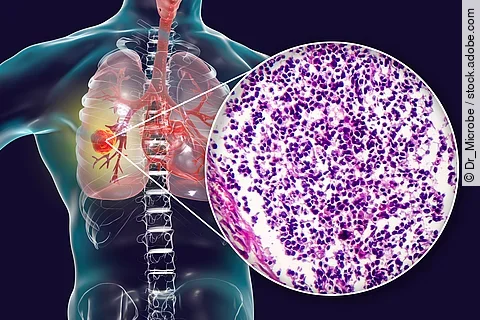 Lung cancer, illustration and photo under microscope