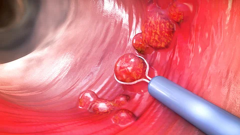 3D‑Darstellung des Inneren des Dickdarms, in dem mehrere Polypen sichtbar sind; ein endoskopisches Instrument greift gerade einen dieser Polypen zur Entfernung.