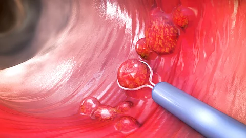 3D‑Darstellung des Inneren des Dickdarms, in dem mehrere Polypen sichtbar sind; ein endoskopisches Instrument greift gerade einen dieser Polypen zur Entfernung.