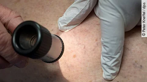 Hautkrebsuntersuchung: Regelmäßige Hautkontrollen können Hautkrebs frühzeitig erkennen und die Heilungschancen deutlich verbessern.