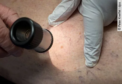 Hautkrebsuntersuchung: Regelmäßige Hautkontrollen können Hautkrebs frühzeitig erkennen und die Heilungschancen deutlich verbessern.