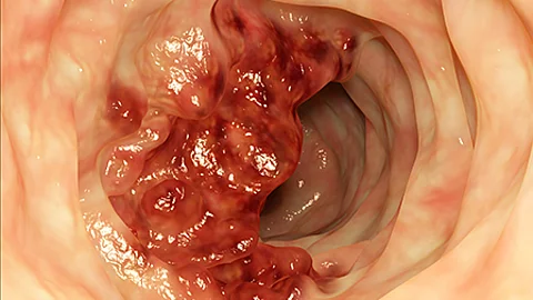 Endoskopische Aufnahme eines großen, unregelmäßig geformten Tumors im Darm