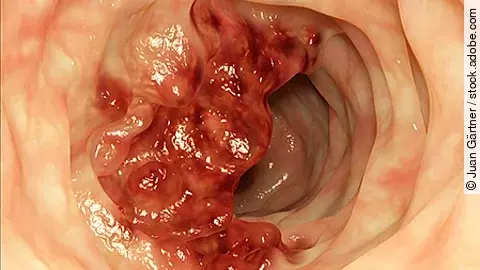 Endoskopische Aufnahme eines großen, unregelmäßig geformten Tumors im Darm