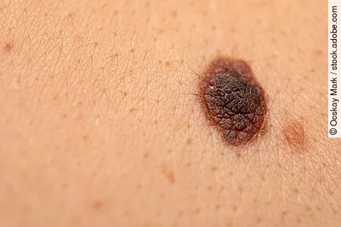 Dangerous nevus on skin - melanoma