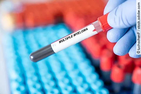 Multiple Myeloma. Multiple Myeloma disease blood test inmedical laboratory