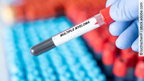 Multiple Myeloma. Multiple Myeloma disease blood test inmedical laboratory