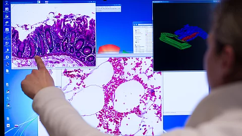Ein Mitarbeiter zeigt im Institut der Pathologie der Universitätsklinik Charité in Berlin an einem Computerbildschirm auf eine Darstellung einer eingescannten Probe eines Stück Gewebes aus dem Dickdarm, das bei einer Operation entnommenen wurde.