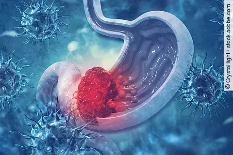 Stomach cancer. Cancer attacking cell. Stomach disease concept